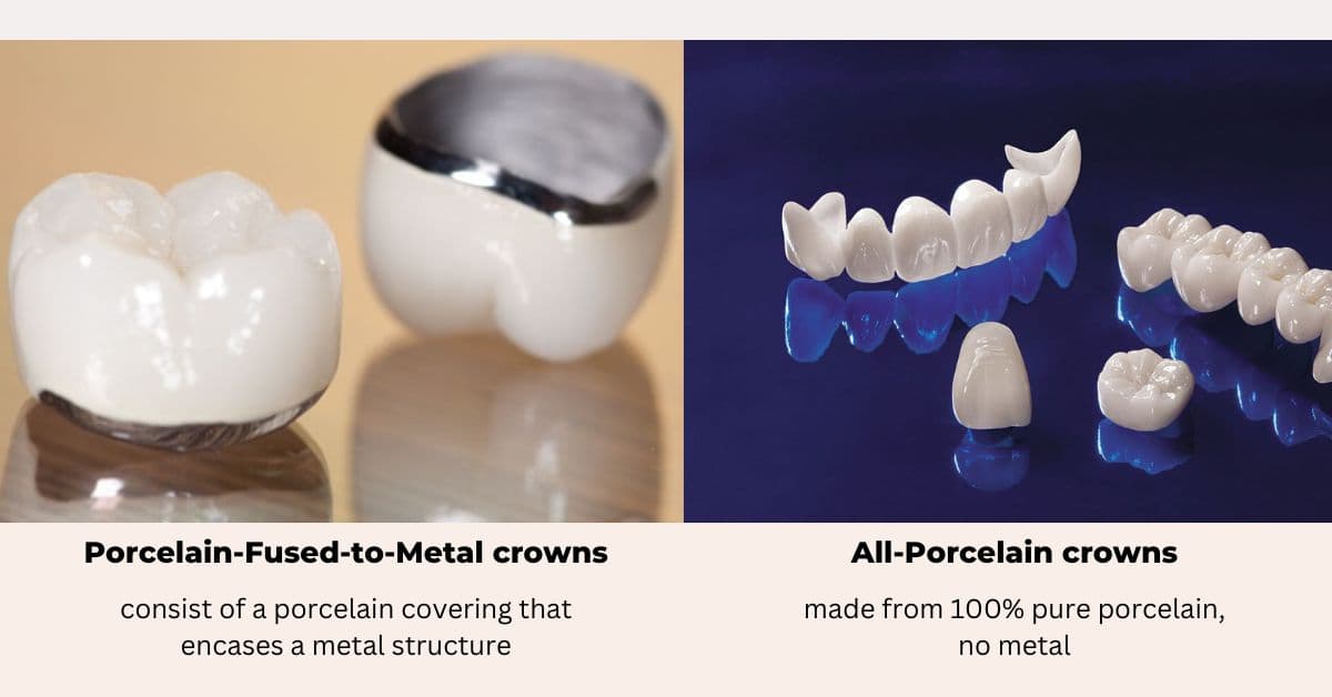 All-Porcelain crowns and Porcelain-Fused-to-Metal crowns