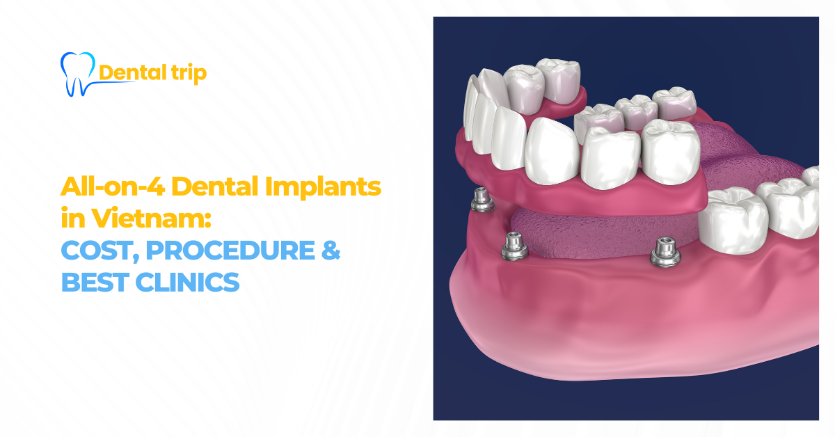 All-on-4 Dental Implants in Vietnam: Cost, Procedure & Top Clinics