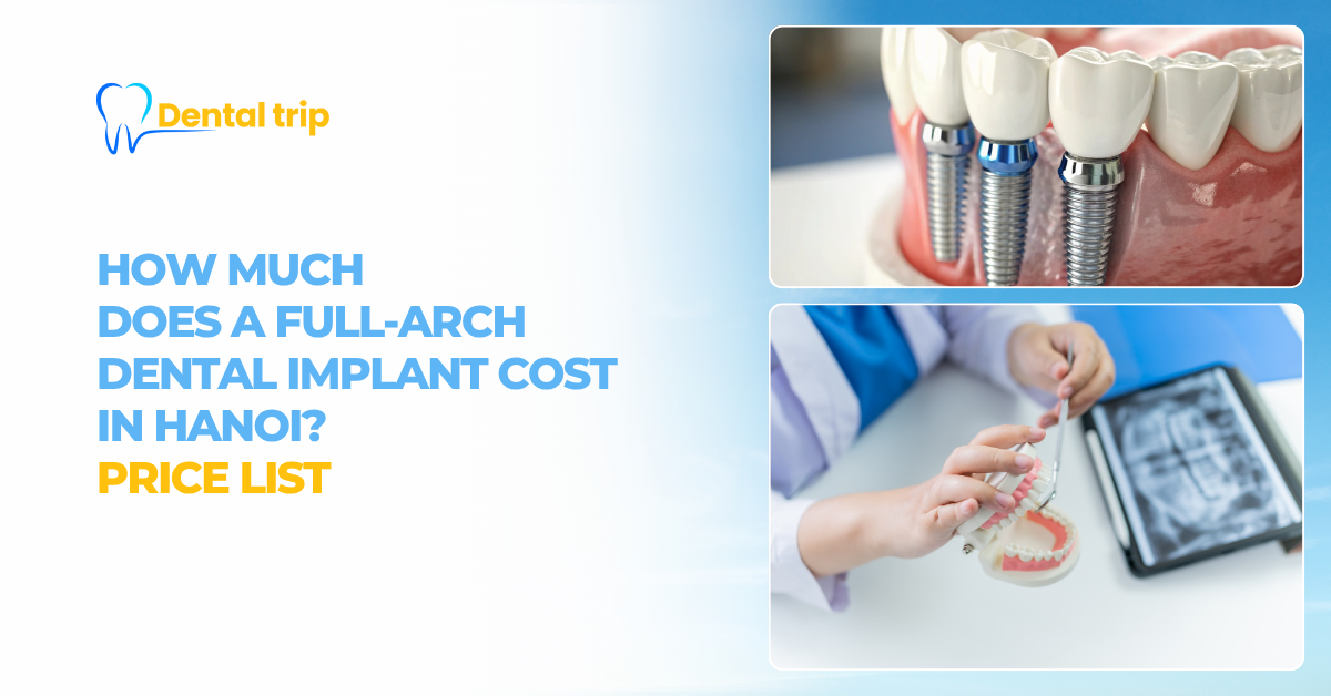 How much does a full-arch dental implant cost in Hanoi? Price list 2026