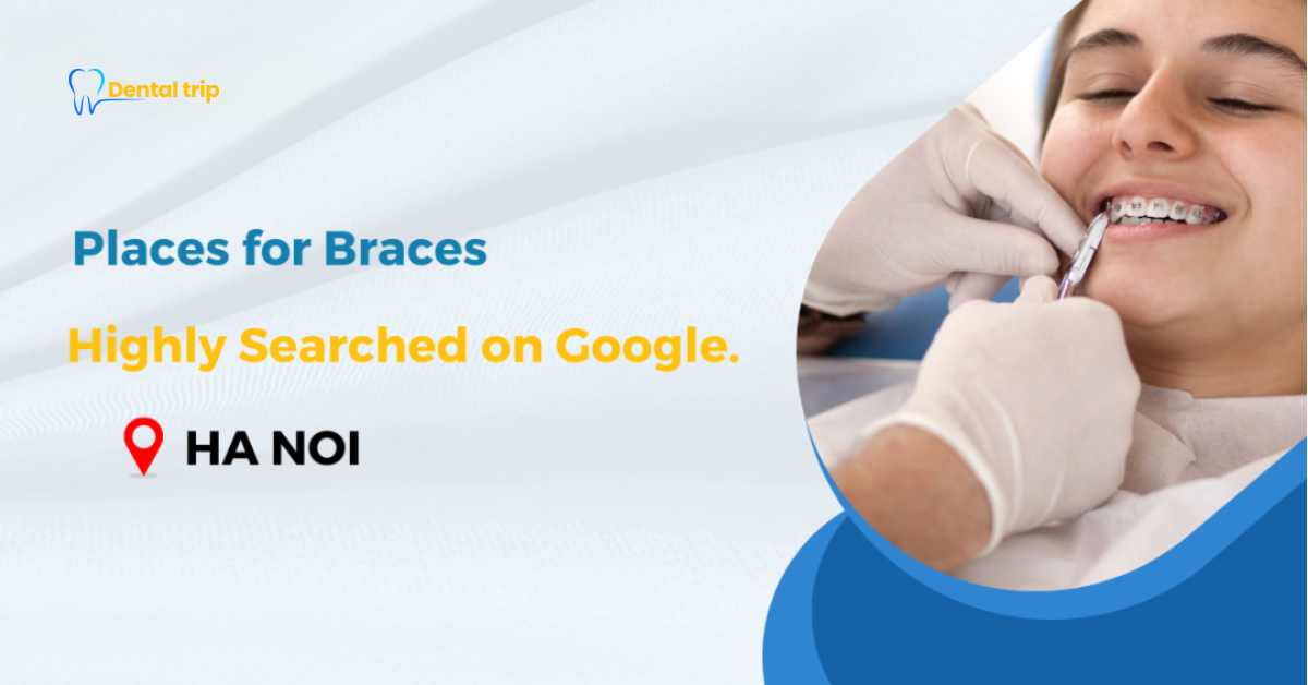 Check out these 8 places for braces in Hanoi that are highly searched on Google