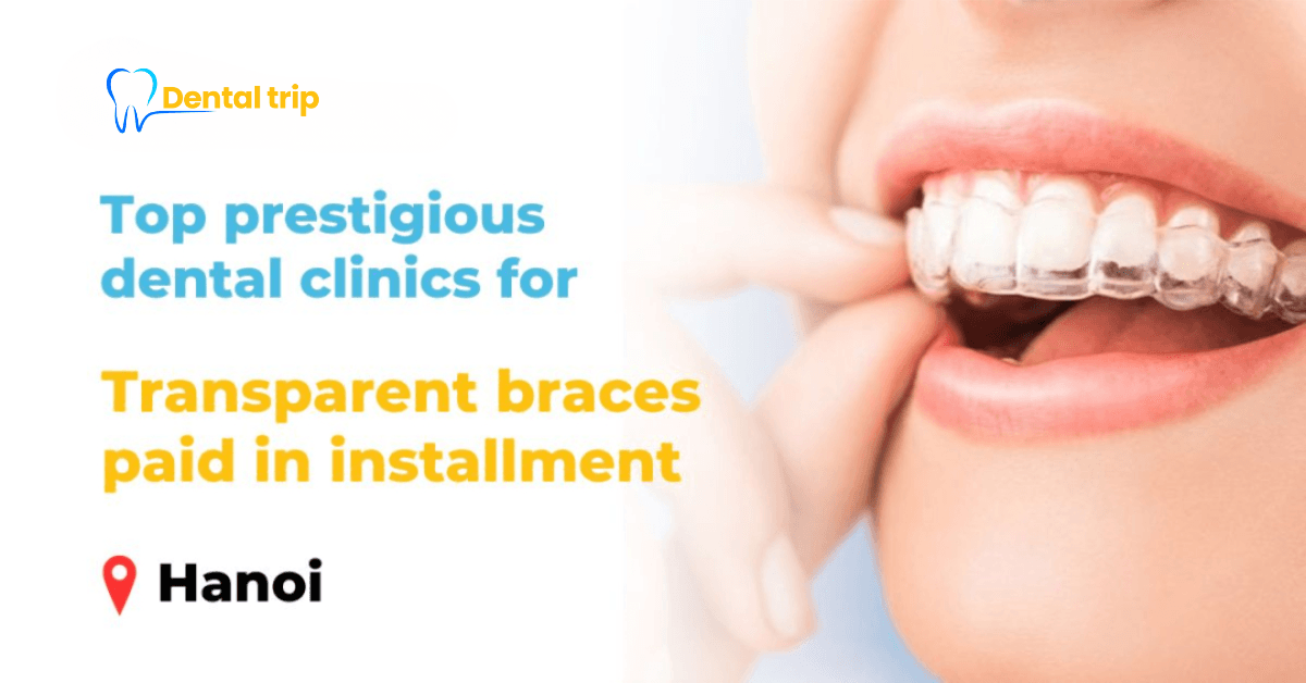 5 prestigious installment payment addresses for transparent braces in Hanoi