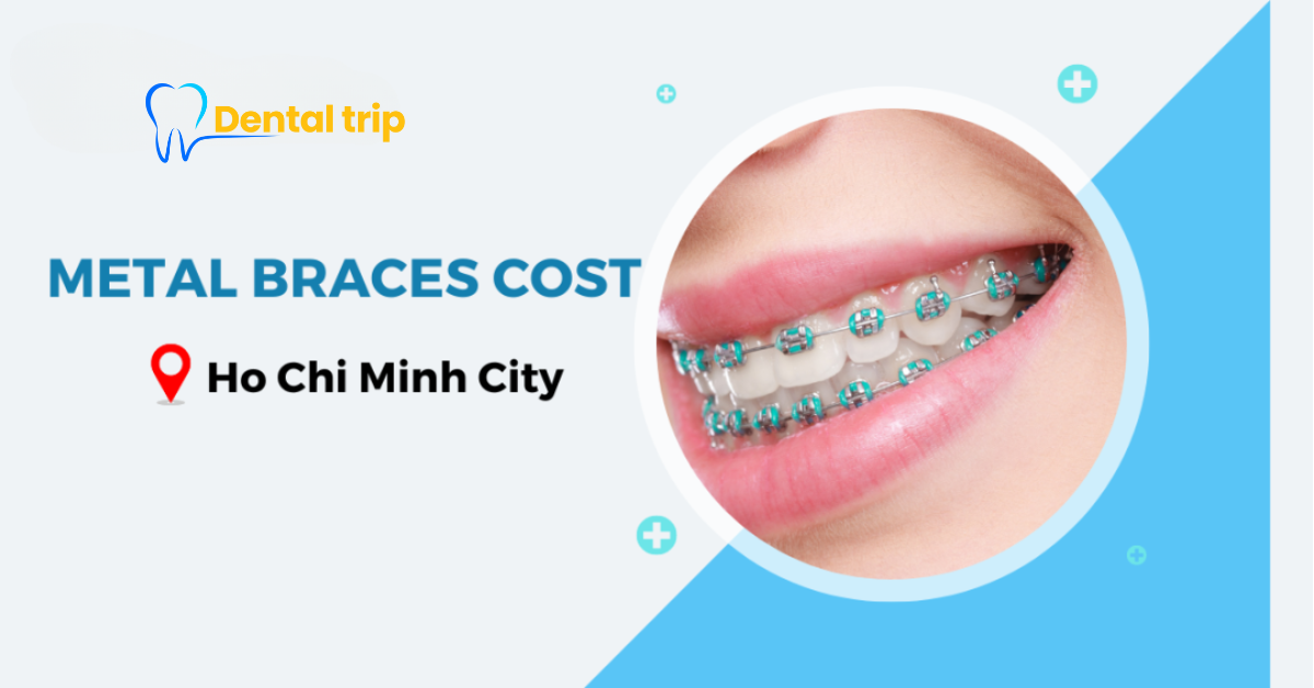 How much do metal braces cost in Ho Chi Minh City? (Updated 2026)