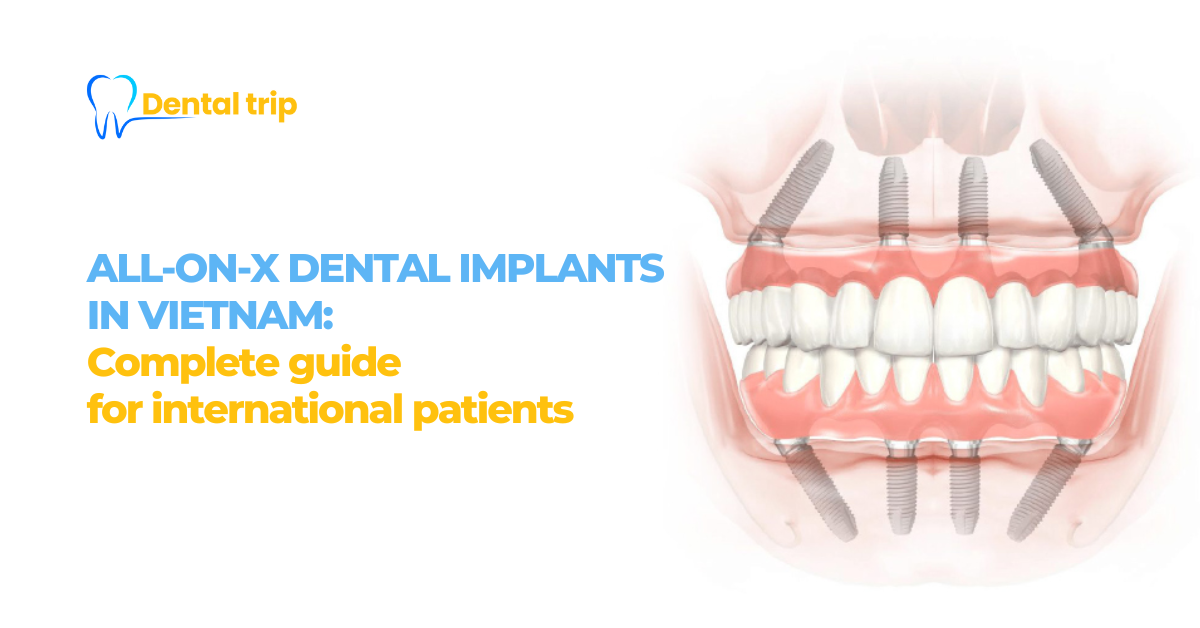 All-on-X dental implants in Vietnam: Complete guide for international patients