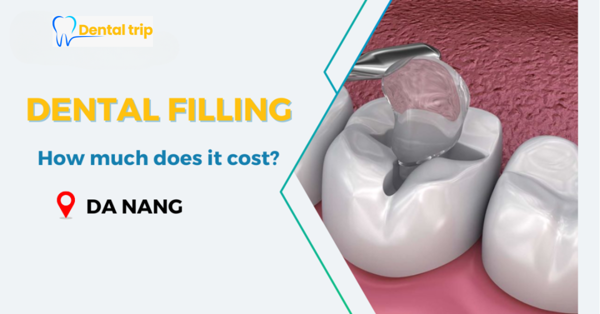 The price list of Dental filling service at 7 reputable dental clinics in Da Nang