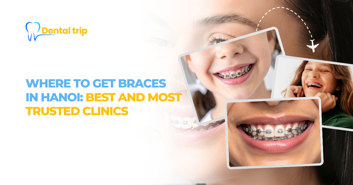 Top 7 reputable clinics for braces in Hanoi (2025 update)