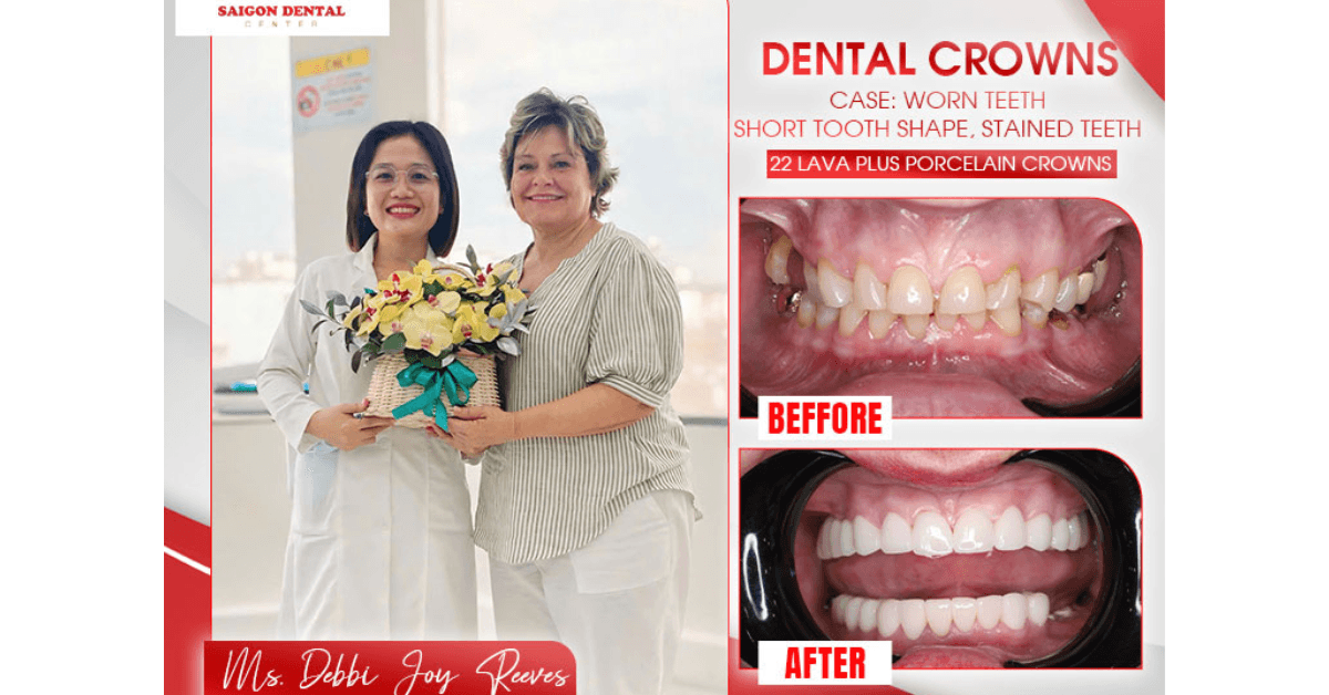 Many international patients choose Vietnam for dental crown treatment