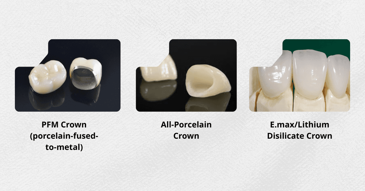 Typical dental crown prices by material in Vietnam