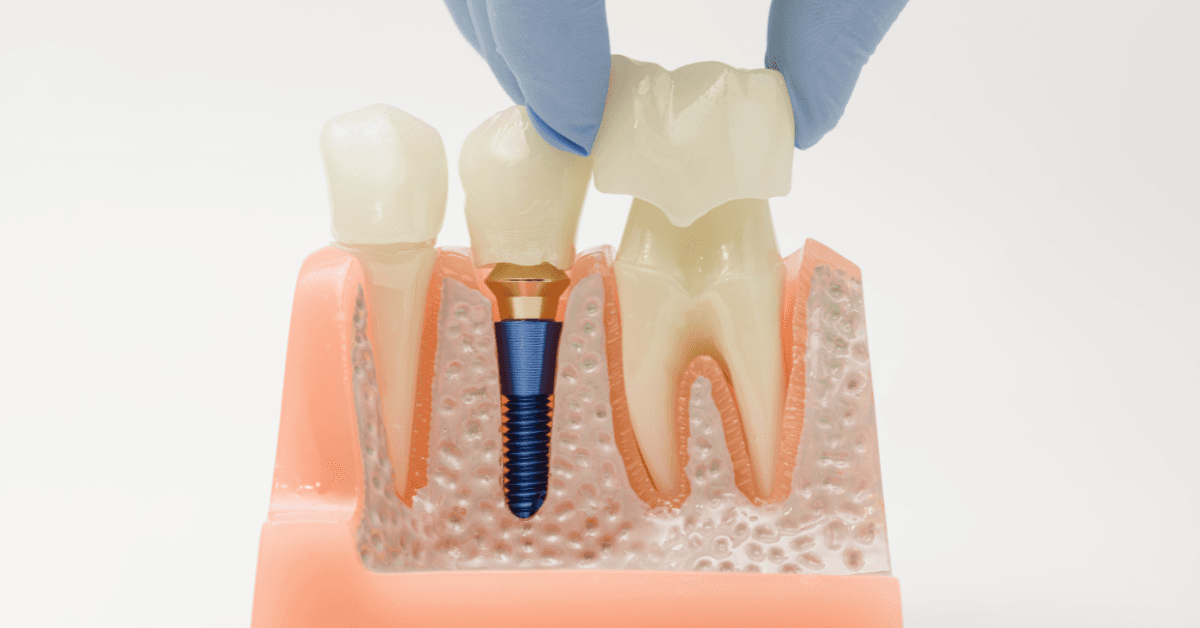 Dental crowns