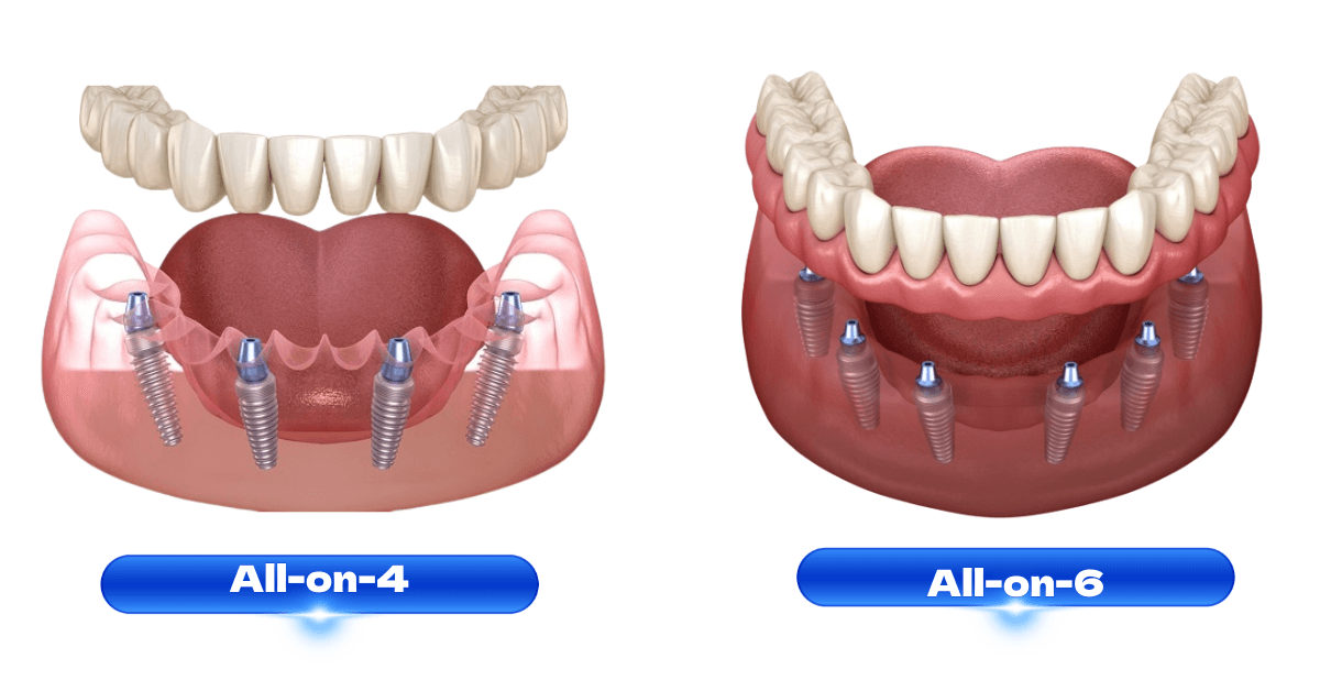 Full mouth dental implant