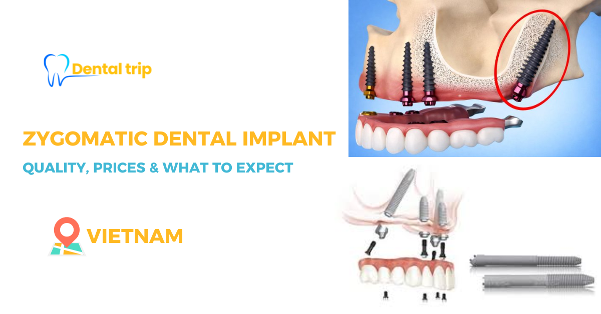 Zygomatic dental implants in Vietnam – Complete guide for overseas patients