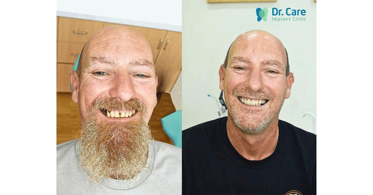 Implant in  Vietnam