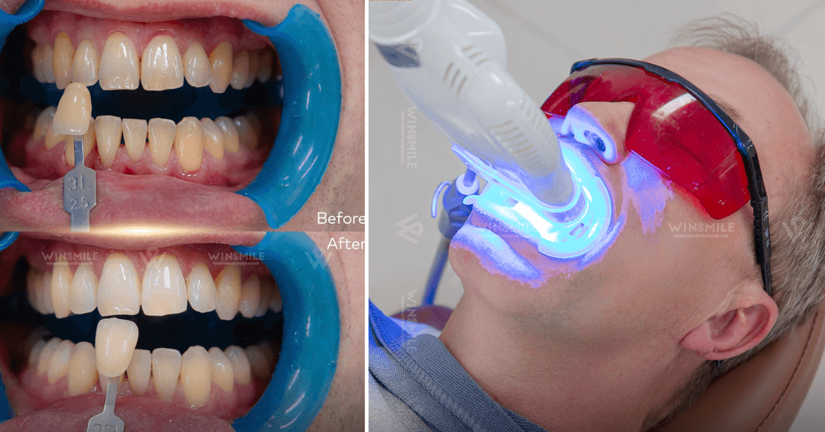 Teeth whitening in Vietnam