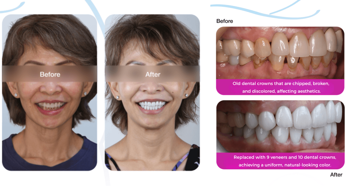 Dental crowns in Vietnam