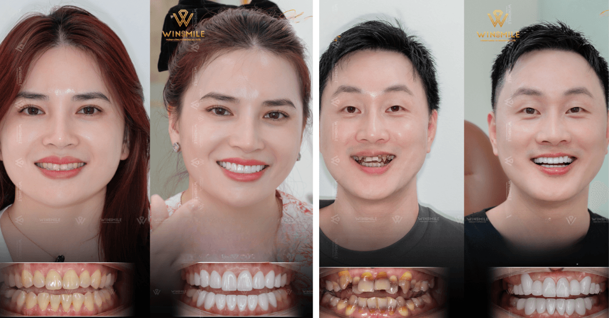 Dental Crown at Win Smile Dental Clinic