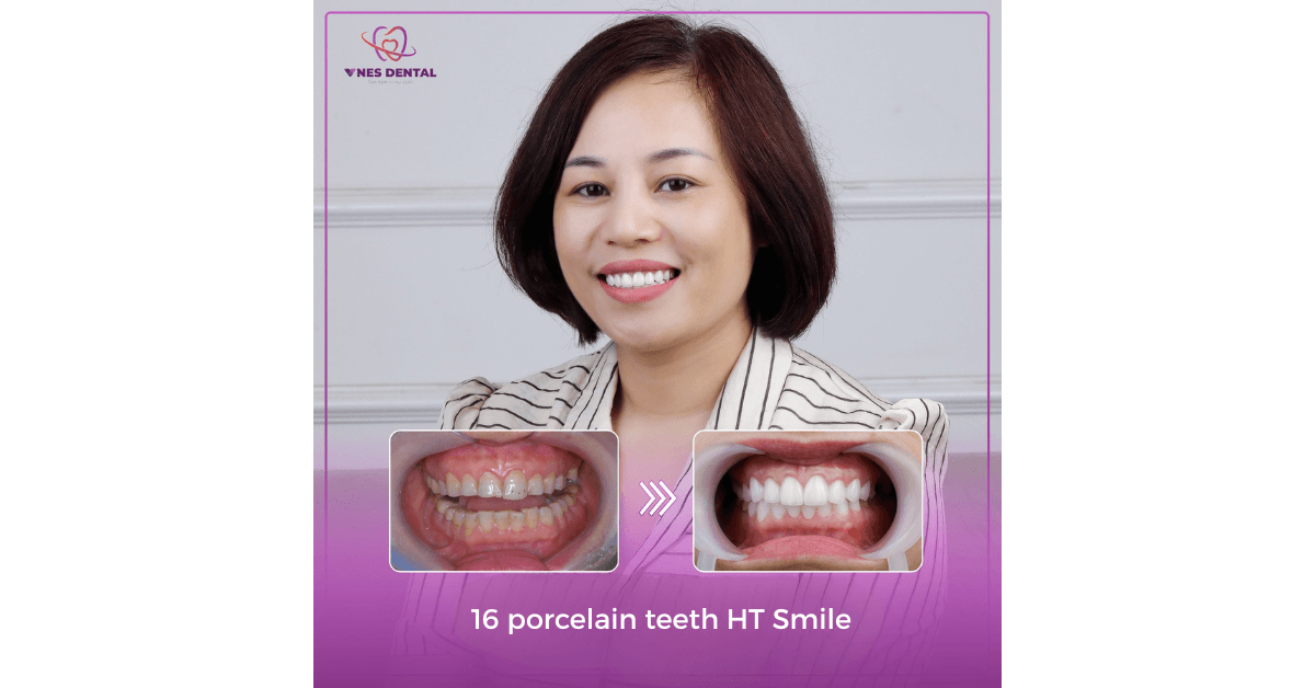 Dental Crown in Vietnam