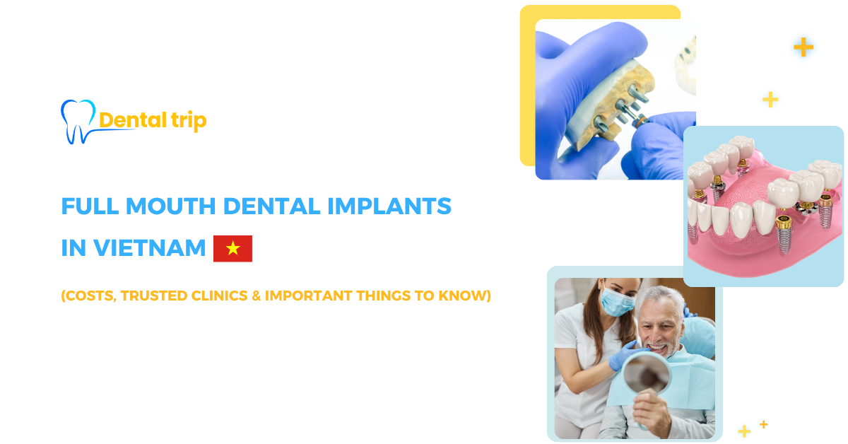 Full Mouth Dental Implants in Vietnam: Costs, Treatment options & Best clinics (2026)