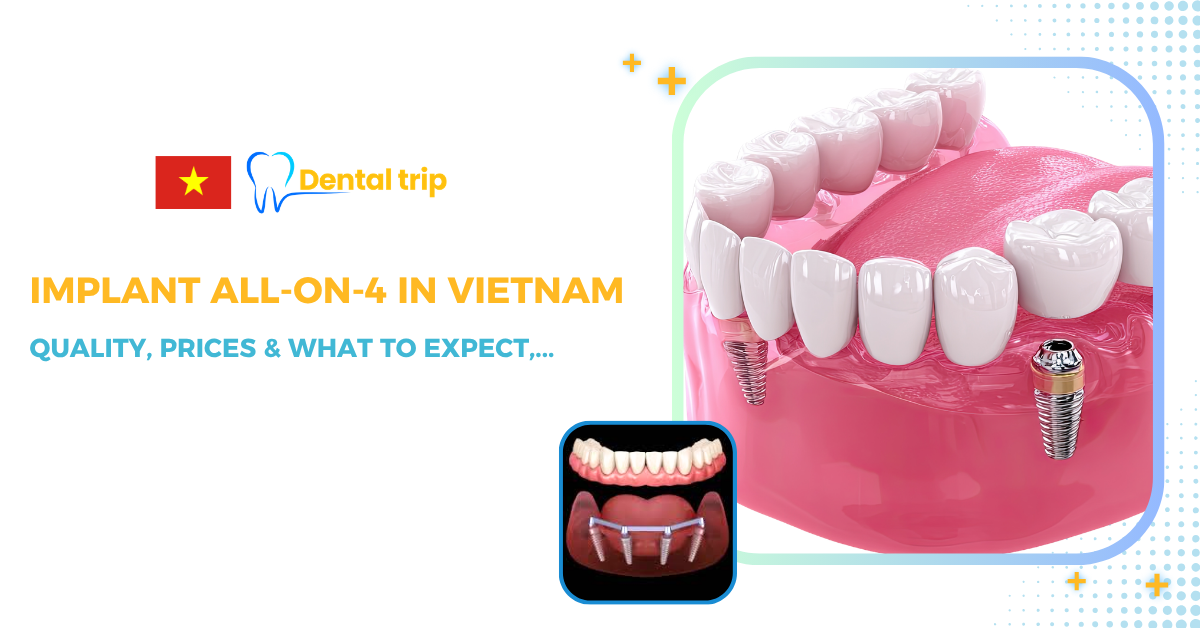 All-on-4 Dental Implants in Vietnam: Costs, Quality & Patient reviews