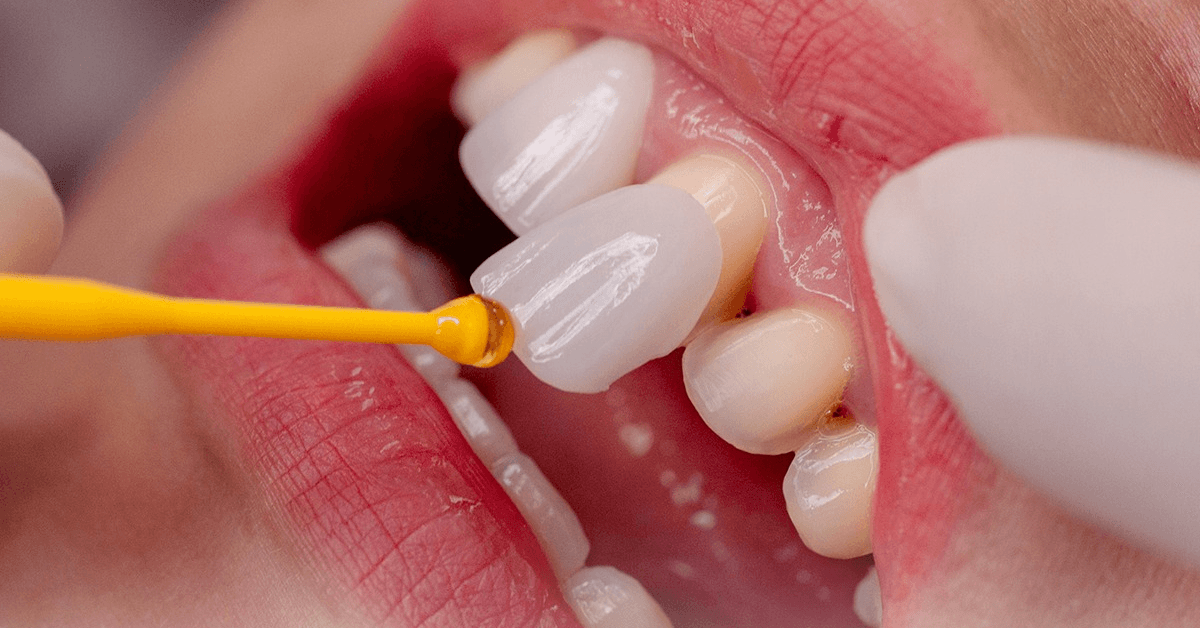 Porcelain veneers