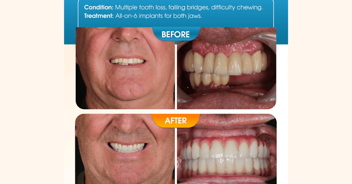 Dental treatment all-on-4