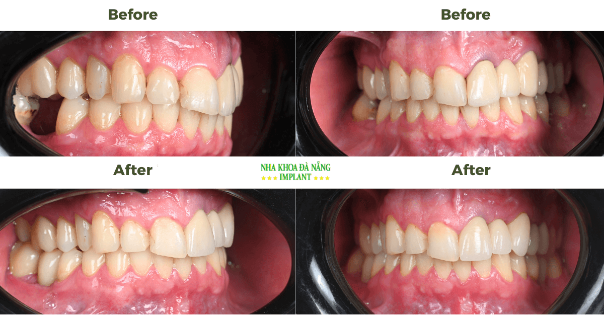 Before & After Dental implants in Da Nang
