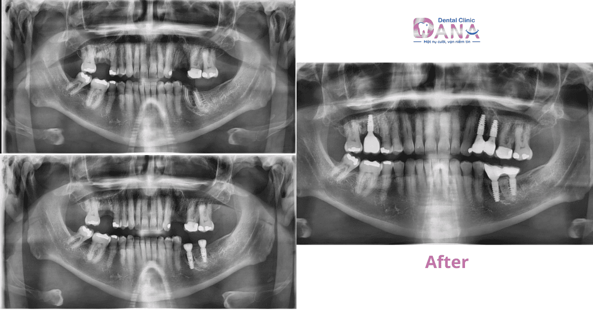 Implant in Da Nang