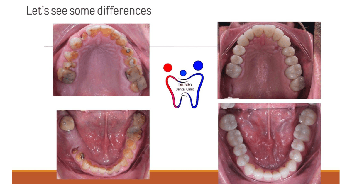 Dental Implant in Da Nang
