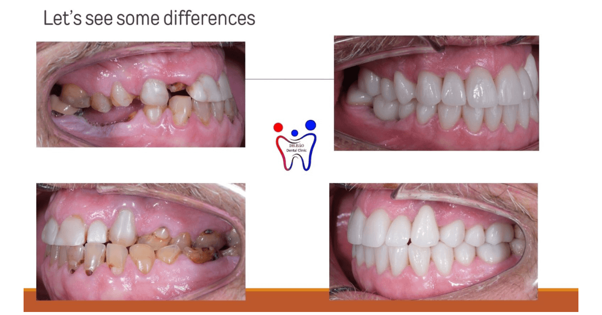 Dental Implant in Da Nang