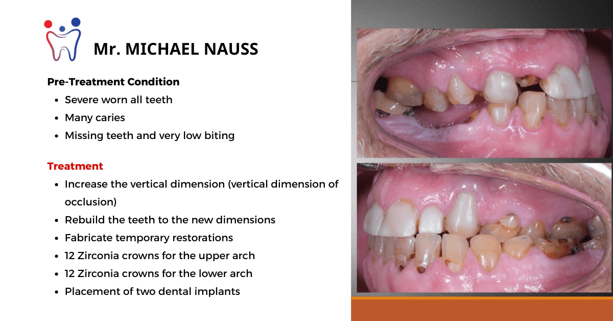 Dental implant in Da Nang