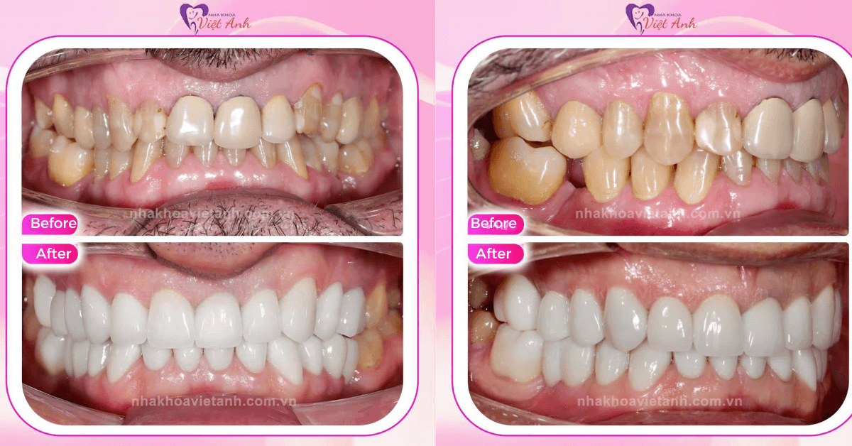 Dental Implants in Da Nang