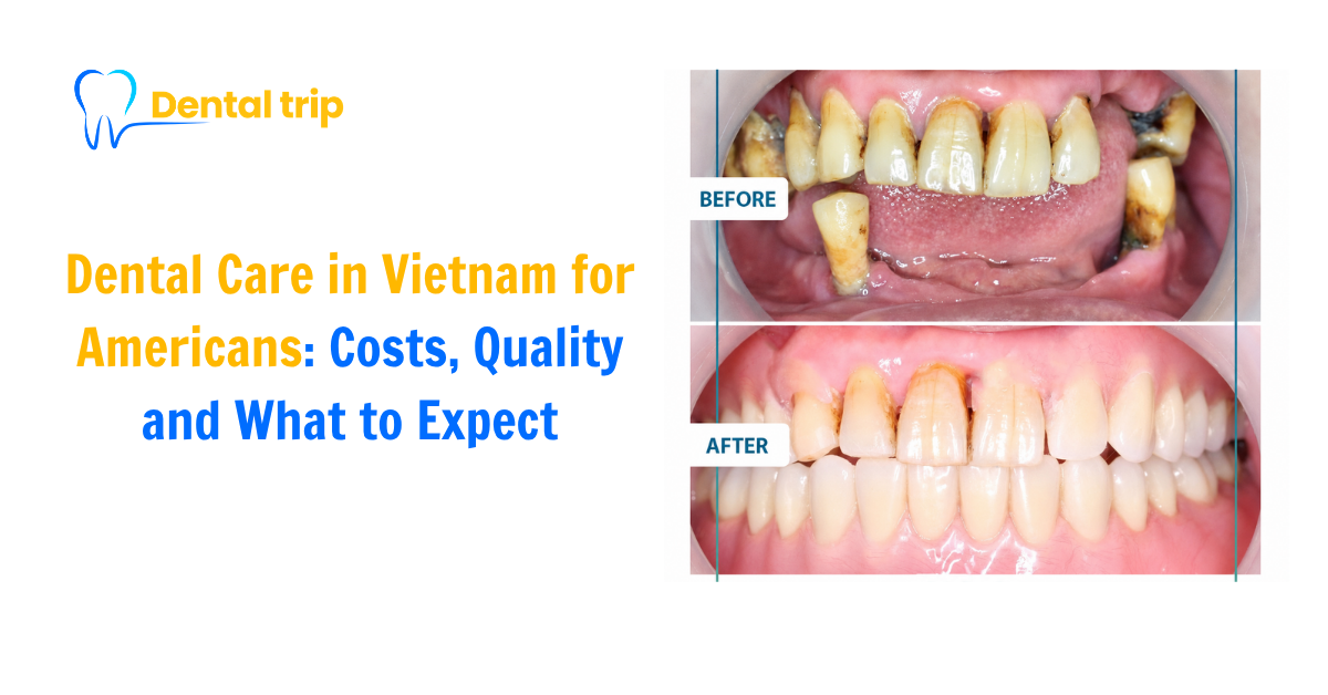 Dental Care in Vietnam for Americans 2026: Costs, Quality and What to Expect