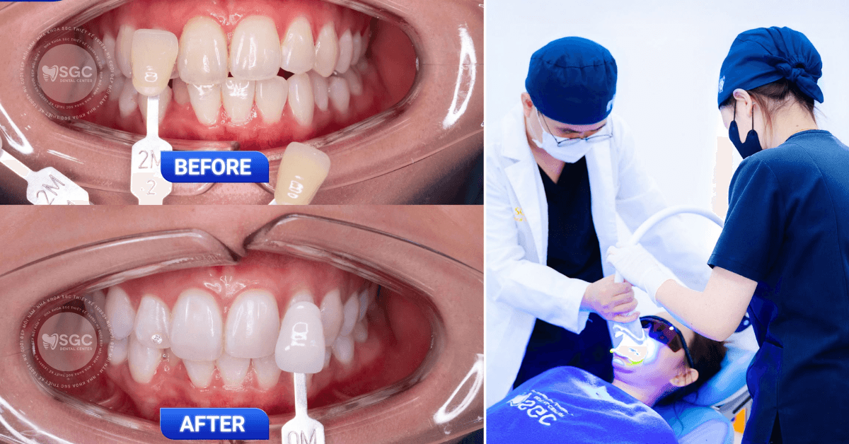 Teeth whitening treatment
