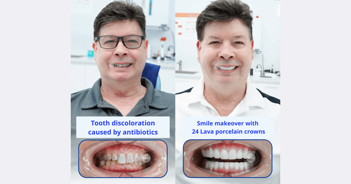 Restoring a Discolored Smile with Ultra-Thin Porcelain Crowns