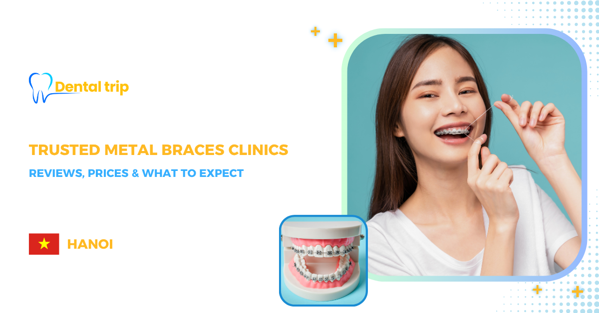 5 Reputable Dental Clinics Offering Metal Braces in Hanoi