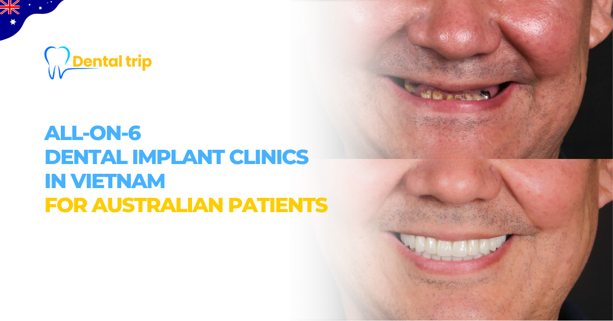All-on-6 Dental implant clinics in Vietnam for Australian patients