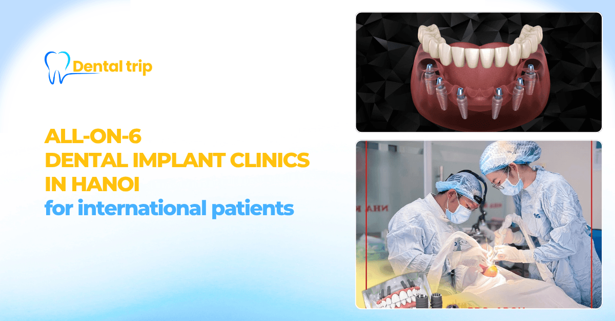 All-on-6 dental implant clinics in Hanoi 