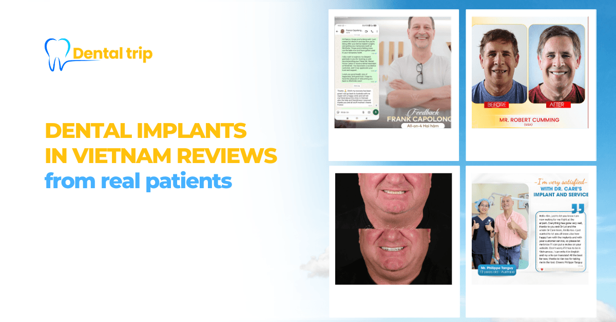 Dental implants in Vietnam reviews from real patients