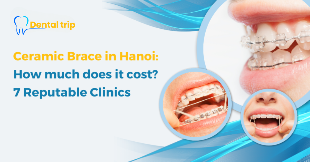 Ceramic braces cost in Hanoi