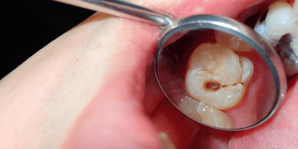 Dental Fillings