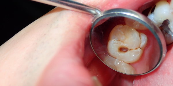 Dental Fillings