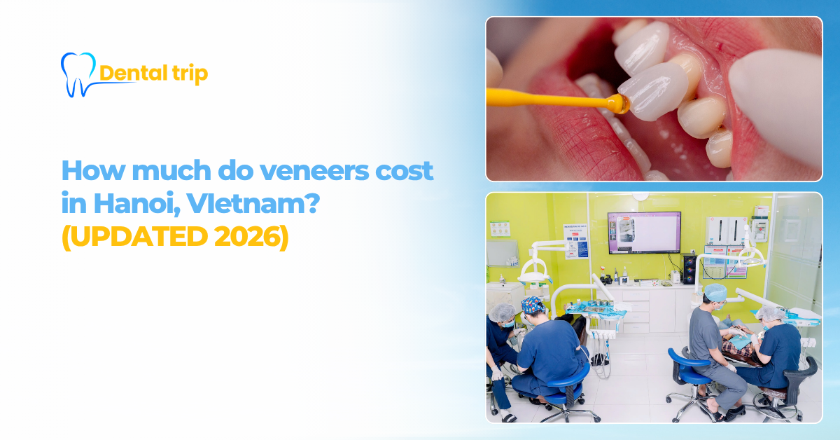 Veneers cost in Hanoi