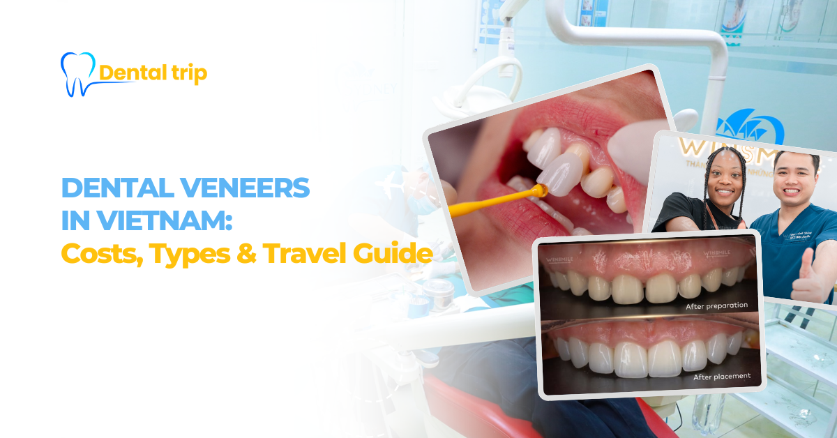 Dental Veneers in Vietnam