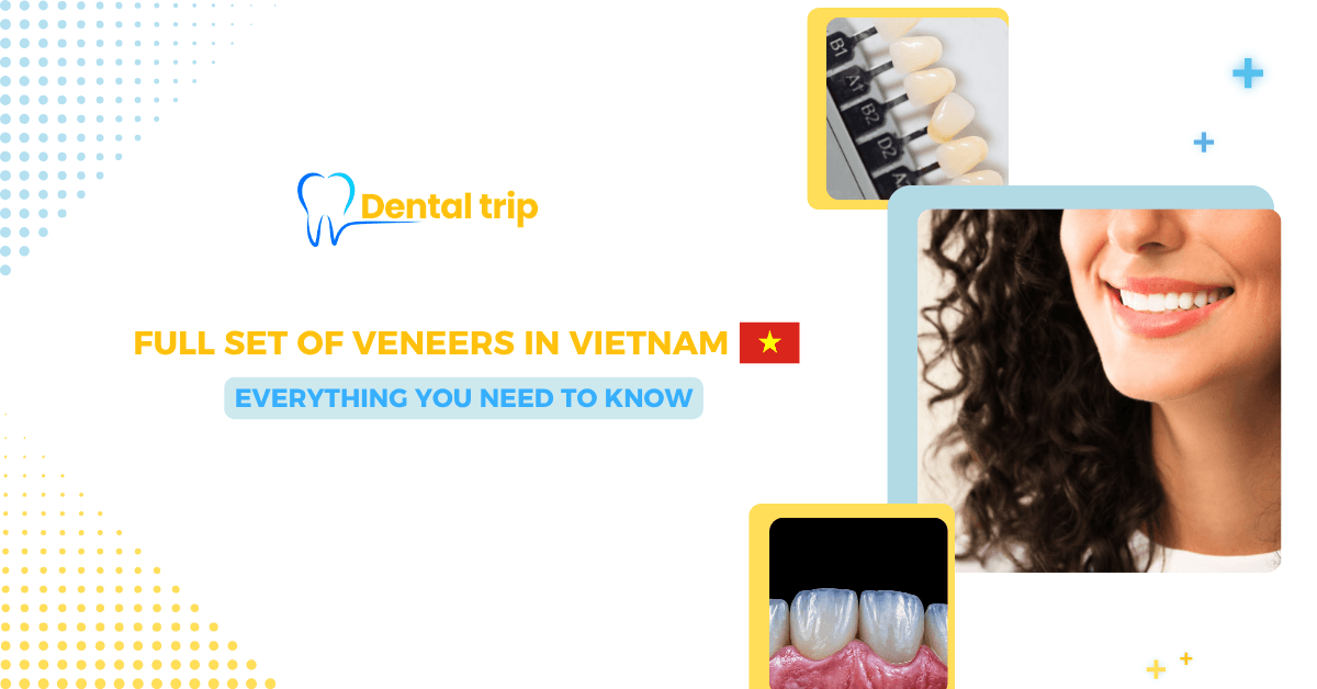 Full Set of Veneers in Vietnam: Cost, Process & What to Expect