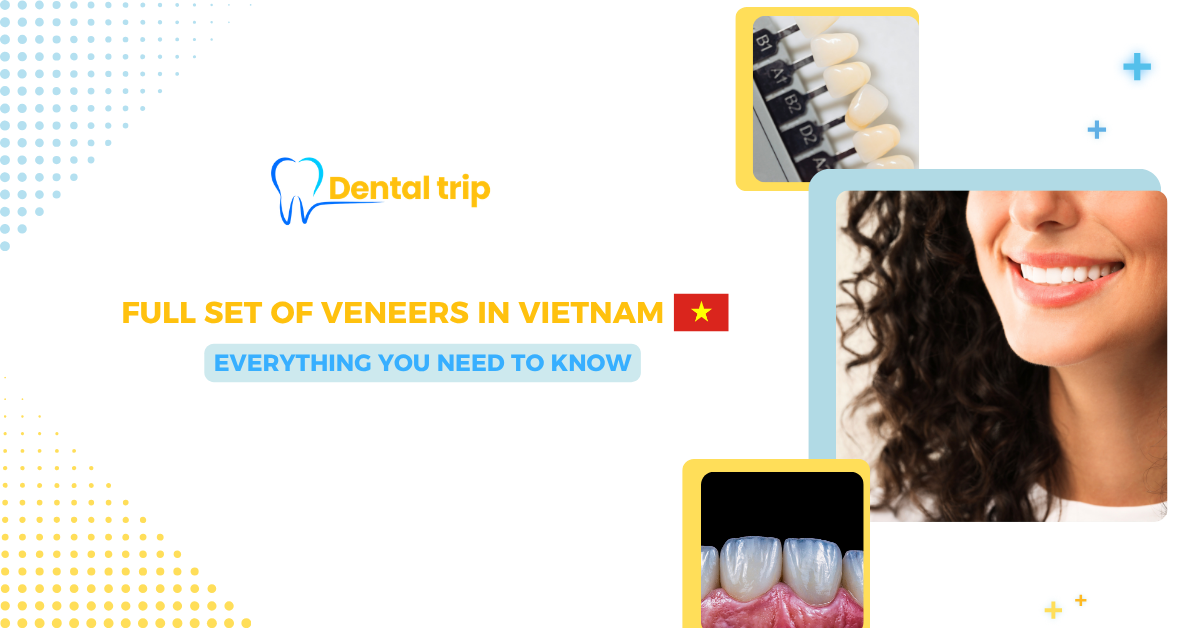 Full Set of Veneers in Vietnam: Cost, Process & What to Expect
