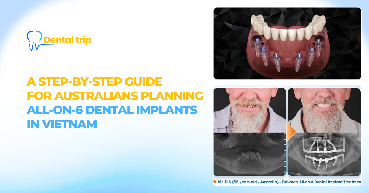 Australians guide to All-on-6 dental implants in Vietnam